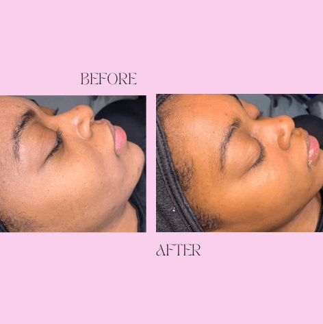 Dermaplaning reveals radient s