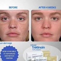 Before and After with Obagi Tr